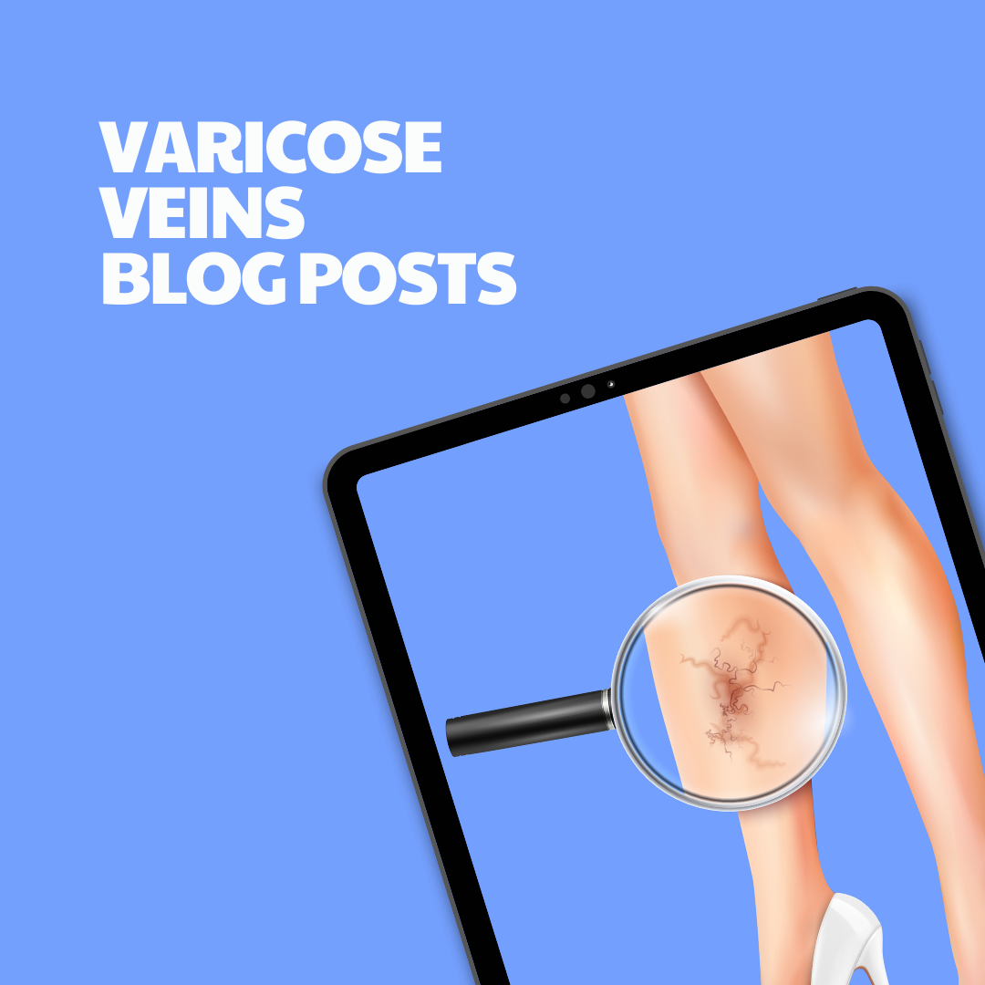 Varicose Veins – 8 Pre-Written Articles